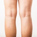 Cirugía de Varices con Láser Endovenoso (2 piernas)