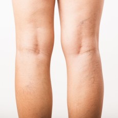 Cirugía de Varices con Láser Endovenoso (2 piernas)