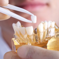 Implante Dental de Titanio con Corona de Zirconio