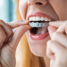 Ortodoncia invisible Angel Aligner Select 10 (ambas arcadas)
