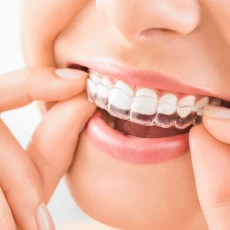 Ortodoncia invisible Angel Aligner Select 30 (ambas arcadas)