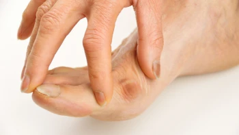 Postoperatorio de la operación de hallux valgus