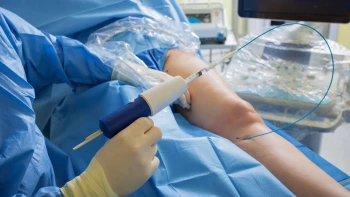 Cirugía de varices: Duración, Precio y Paso a paso