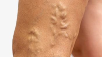 Varices. Complicaciones y Síntomas