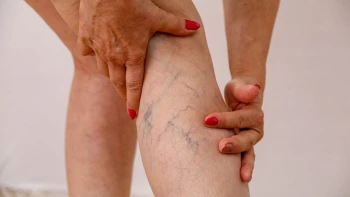 Varices: Qué son, Causas, Síntomas y Tratamientos