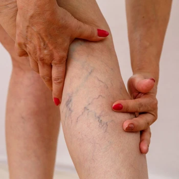 Safenectomía o Fleboextracción Completa (Cirugía de Varices)