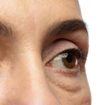 Cirugía de Blefaroplastia inferior (Bolsas de Grasa)