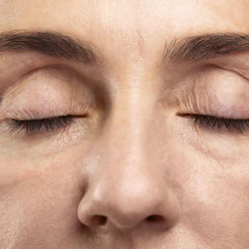 Cirugía de Blefaroplastia Superior (Párpados Caídos)