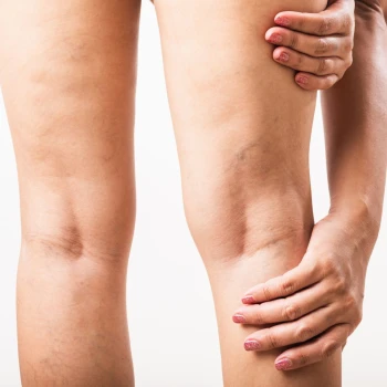 Cirugía de Varices con Láser Endovenoso (1 pierna)