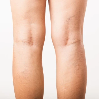 Cirugía de Varices con Láser Endovenoso (2 piernas)