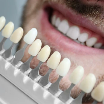 Carillas Dentales de Alta Estética (por diente)