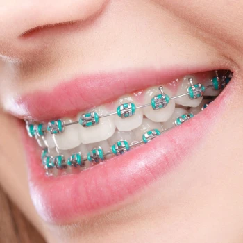 Tratamiento de Ortodoncia con Brackets Metálicos (ambas arcadas)