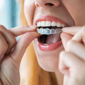 Ortodoncia invisible Angel Aligner Select 10 (ambas arcadas)
