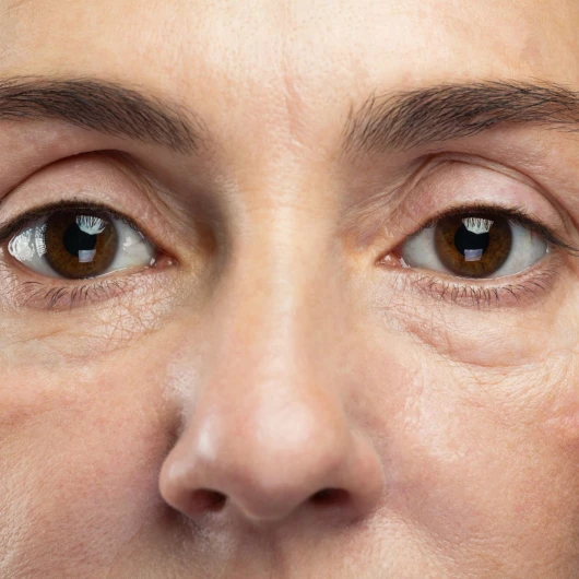 Blefaroplastia Completa (Párpados Superiores e Inferiores)