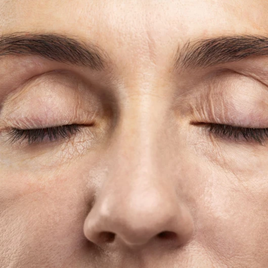 Cirugía de Blefaroplastia Superior (Párpados Caídos)