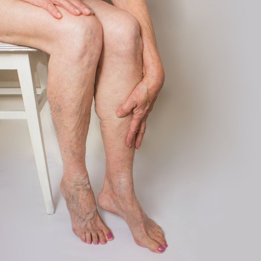 Cirugía de Varices por Radiofrecuencia (2 piernas)