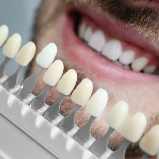 Carillas Dentales de Alta Estética (por diente)