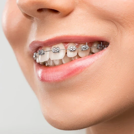 Tratamiento de Ortodoncia Vestibular Fija con Brackets Autoligables (ambas arcadas)