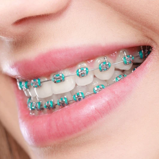 Tratamiento de Ortodoncia con Brackets Metálicos (ambas arcadas)