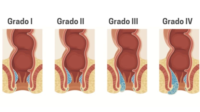 Desarterialización hemorroidal guiada por doppler (THD)