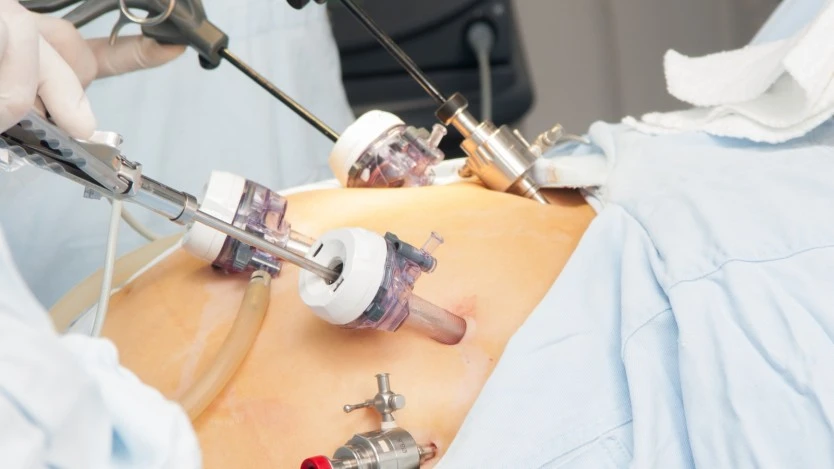 Operación de Hernia de Hiato