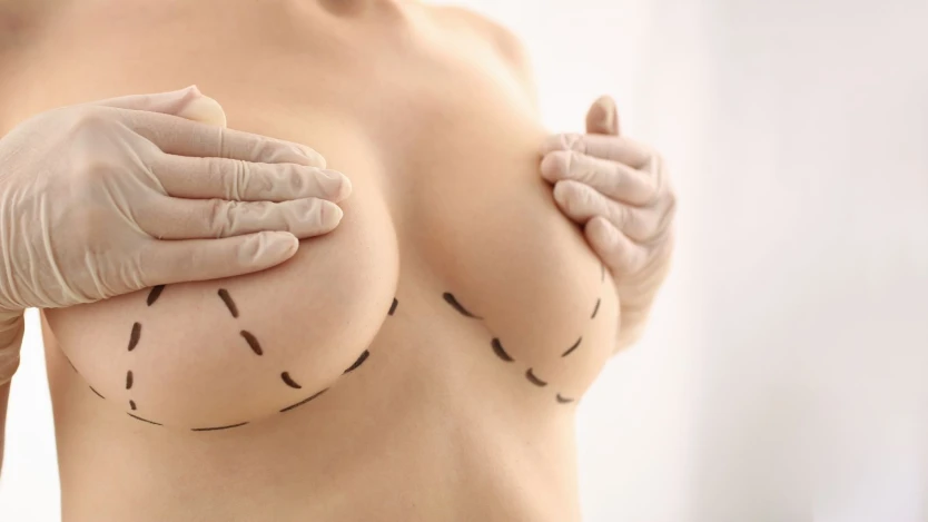 Edad habitual de las pacientes de mamoplastia