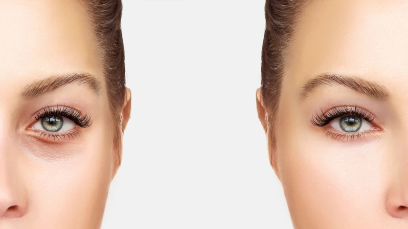 Cirugía de blefaroplastia