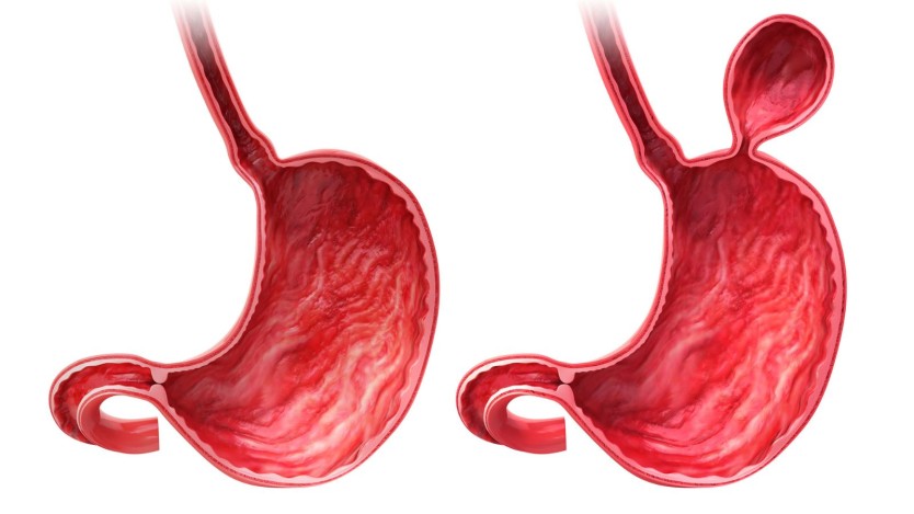 Hernia de hiato