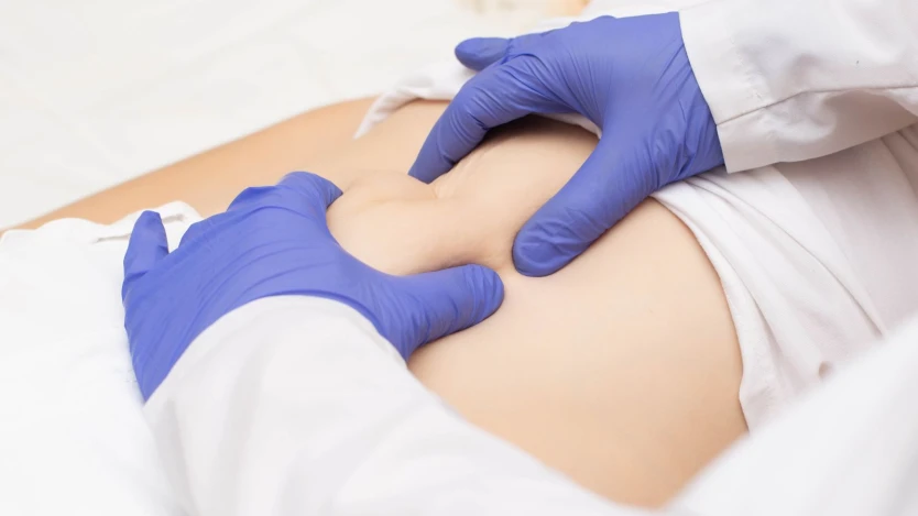 Cirugía de hernia umbilical