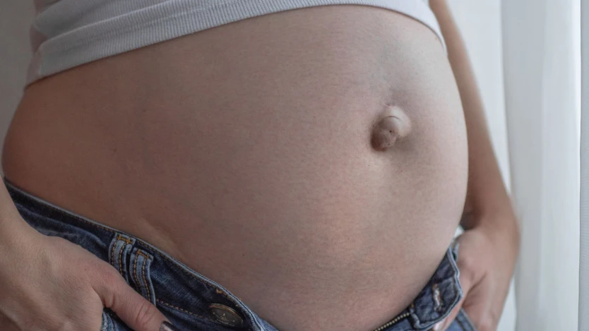 Tipos de hernia en el ombligo
