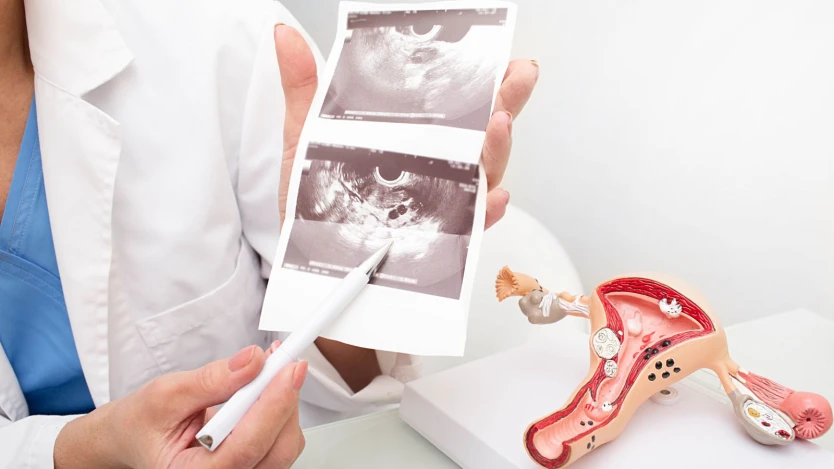Ecografía de miomas uterinos