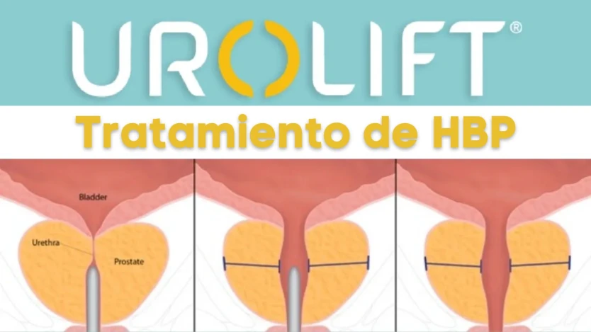 Cirugía de próstata con sistema urolift