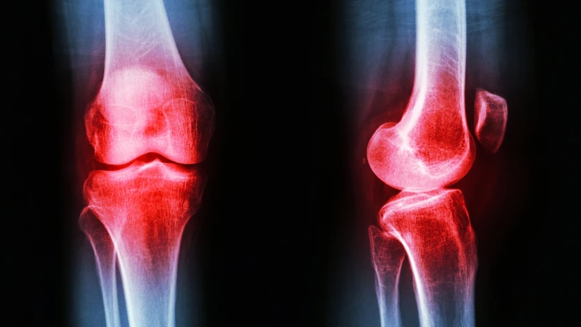 Artrosis de rodilla