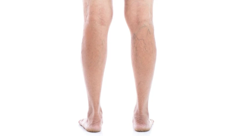 Aspecto de las varices