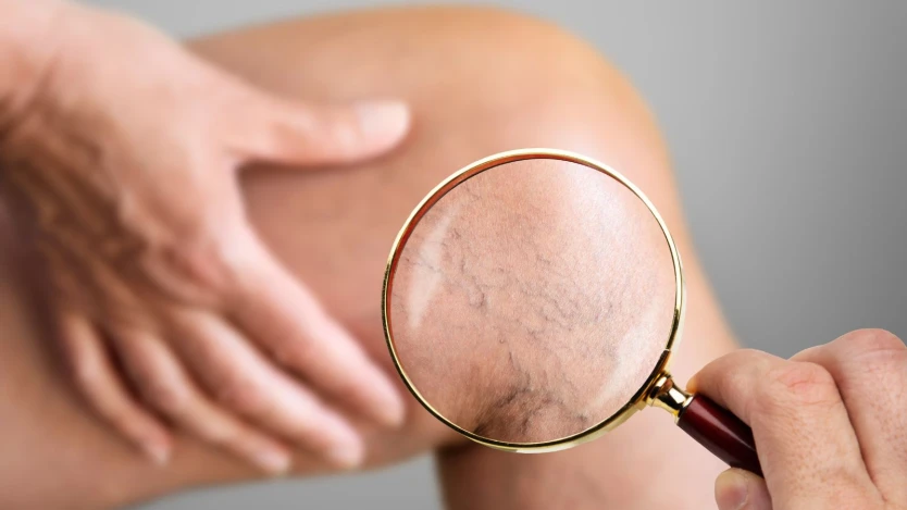 Diagnóstico de varices