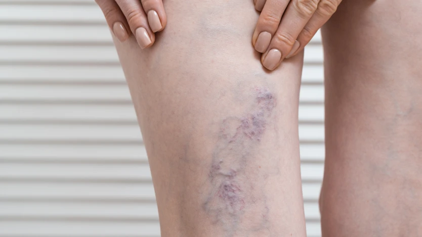 Varices