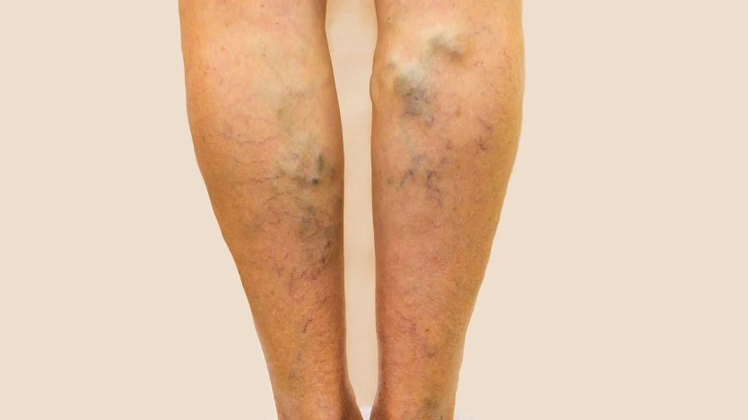 Varices inflamadas