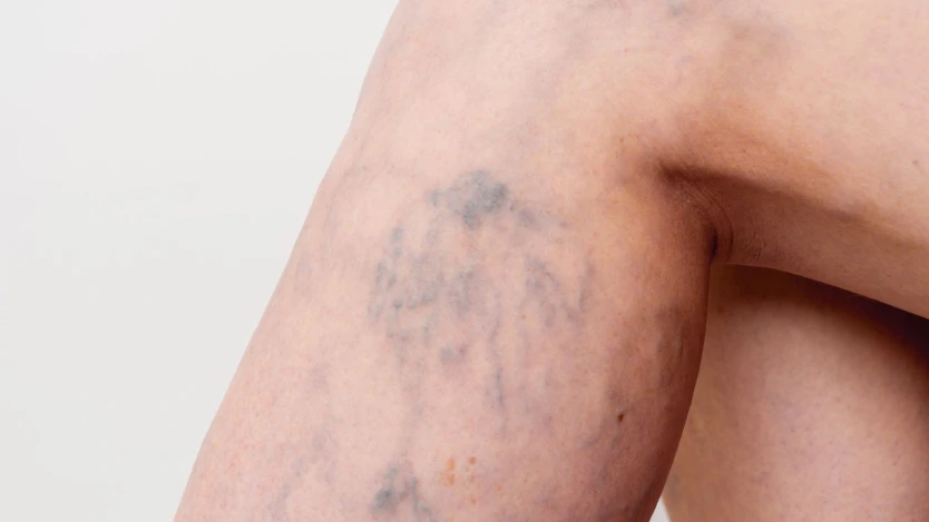 Varices