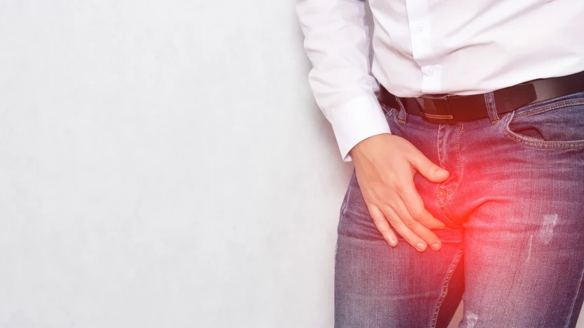 Varicocele testicular