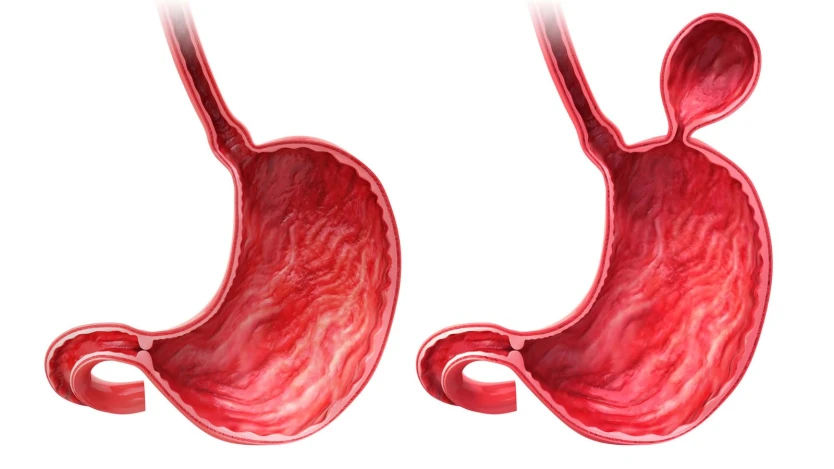 Hernia de hiato: Qué es, Causas, Síntomas y Tratamientos