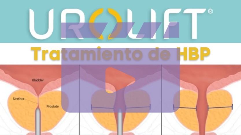 [Vídeo] Sistema Urolift, funcionamiento, ventajas y efectos secundarios