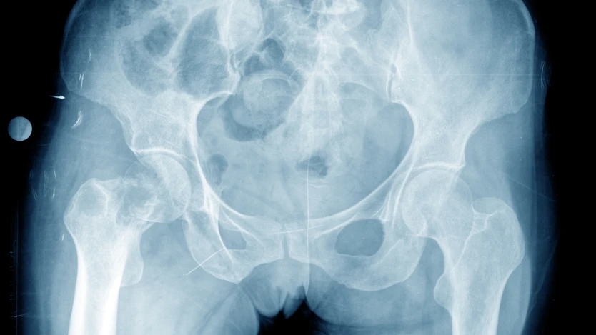 Anatomía de la articulación de la cadera