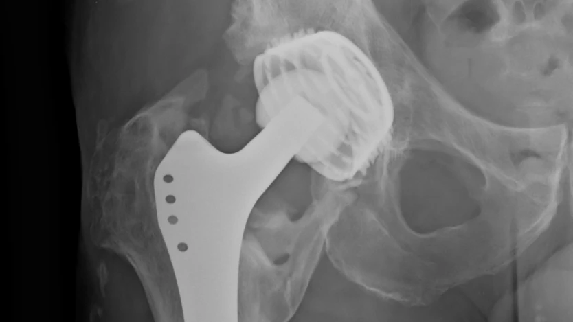 Implantes de cadera, tipos, causas y cirugía