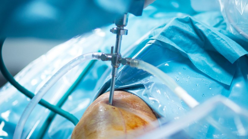¿Cuánto dura la operación de prótesis de rodilla?