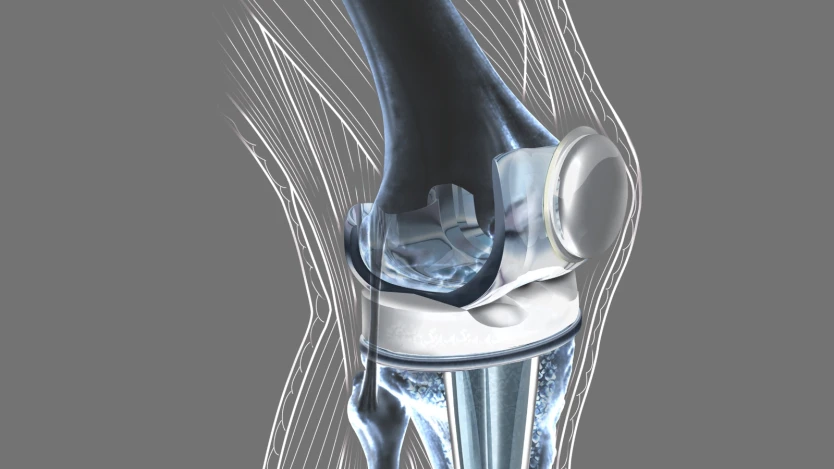 Componentes de una prótesis de rodilla