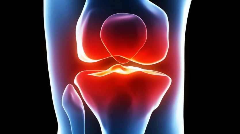 ¿Cuándo es recomendable la prótesis de rodilla?